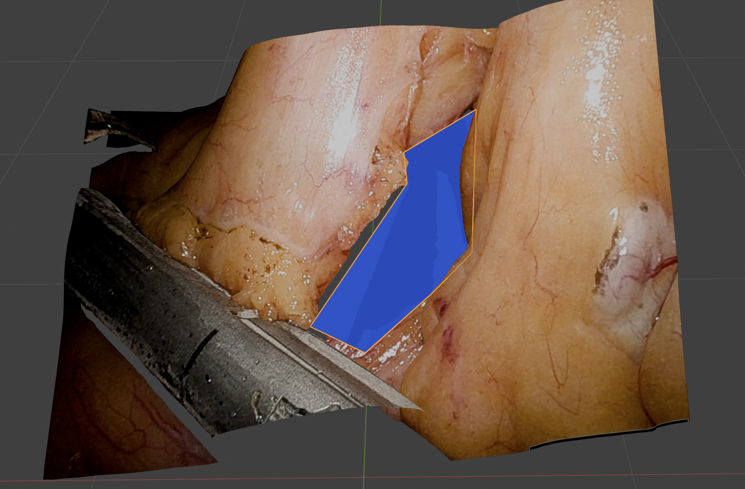 Deep learning approach for critical exposure during division of the inferior mesenteric artery in colorectal surgery